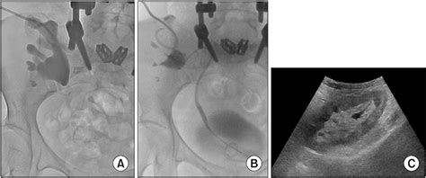 adam marcheluk|Reconstruction of long ureteral obstructions using xenogenic。